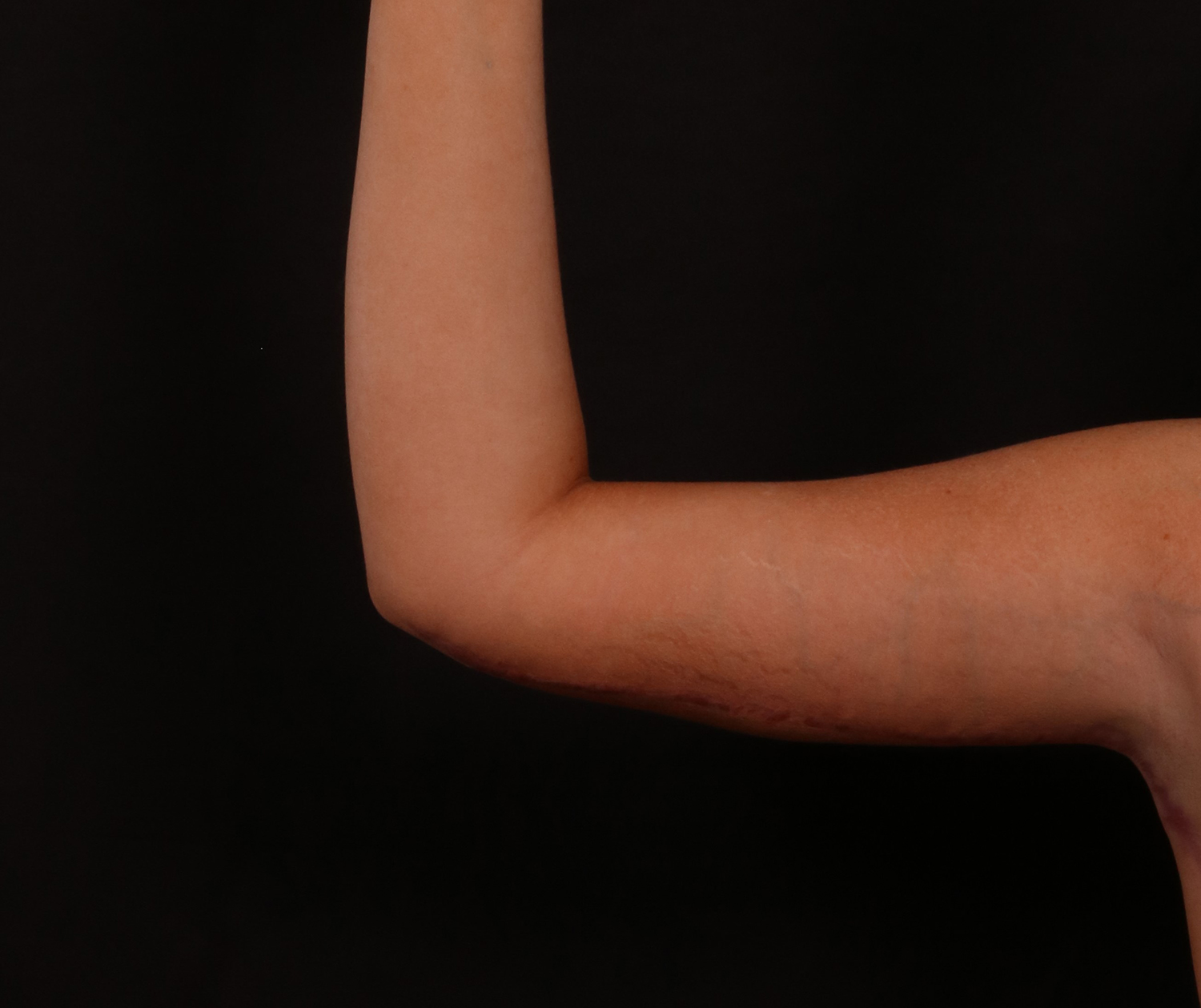 After Image: Brachioplasty - front