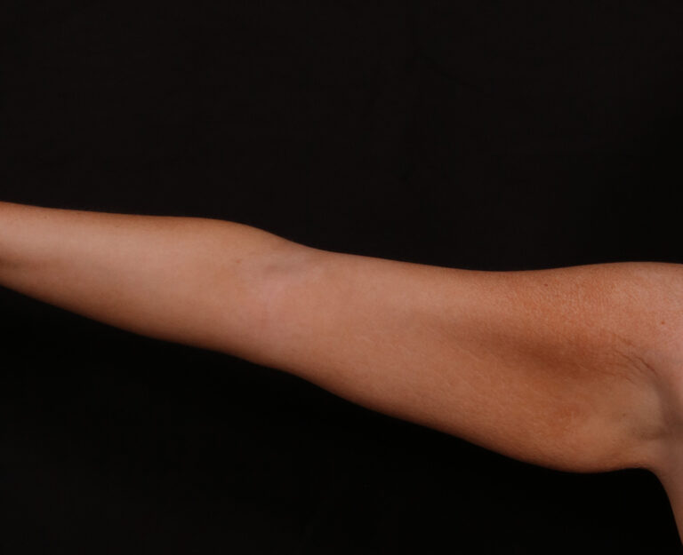 Before Image: Brachioplasty - front
