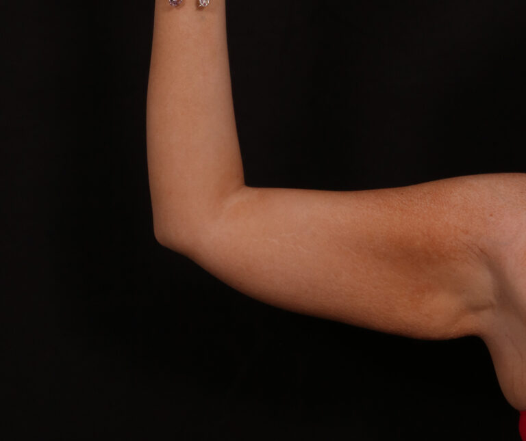 Before Image: Brachioplasty - front