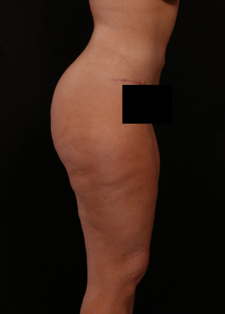 After Image: Tummy Tuck - right-side