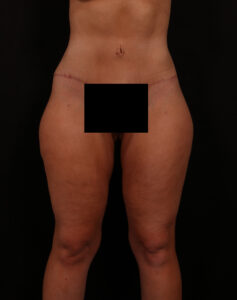 After Image: Tummy Tuck