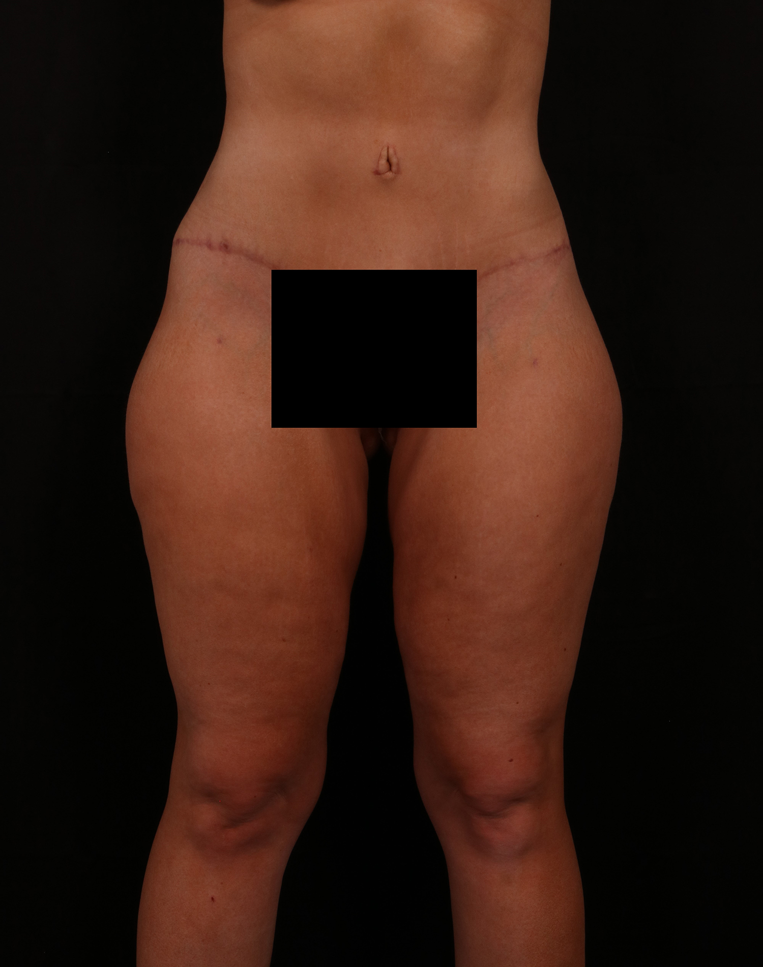 After Image: Tummy Tuck - front