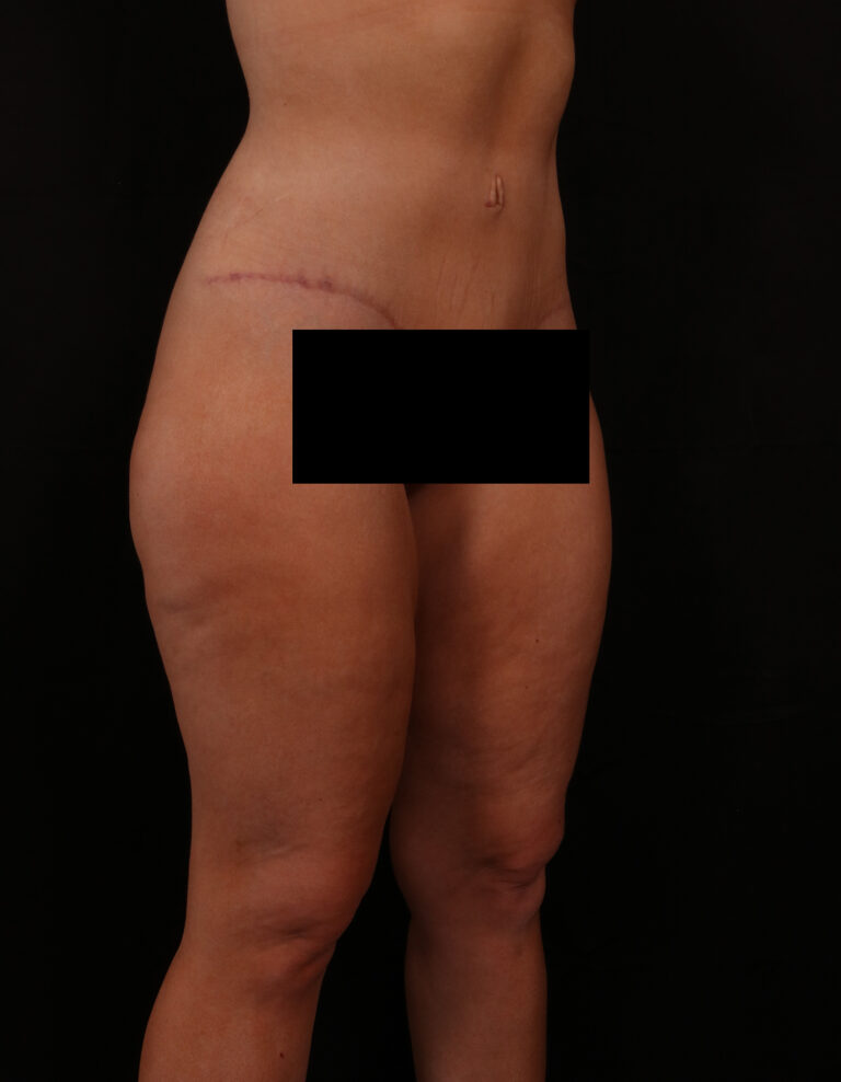 After Image: Tummy Tuck - right-front-oblique