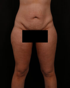 Before Image: Tummy Tuck