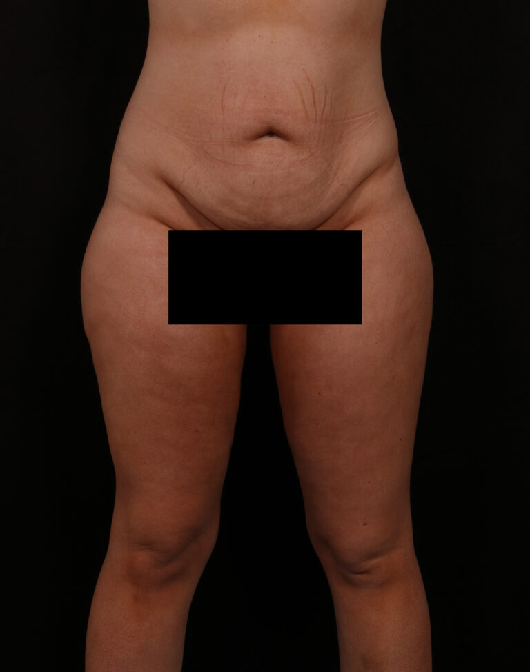 Before Image: Tummy Tuck - front