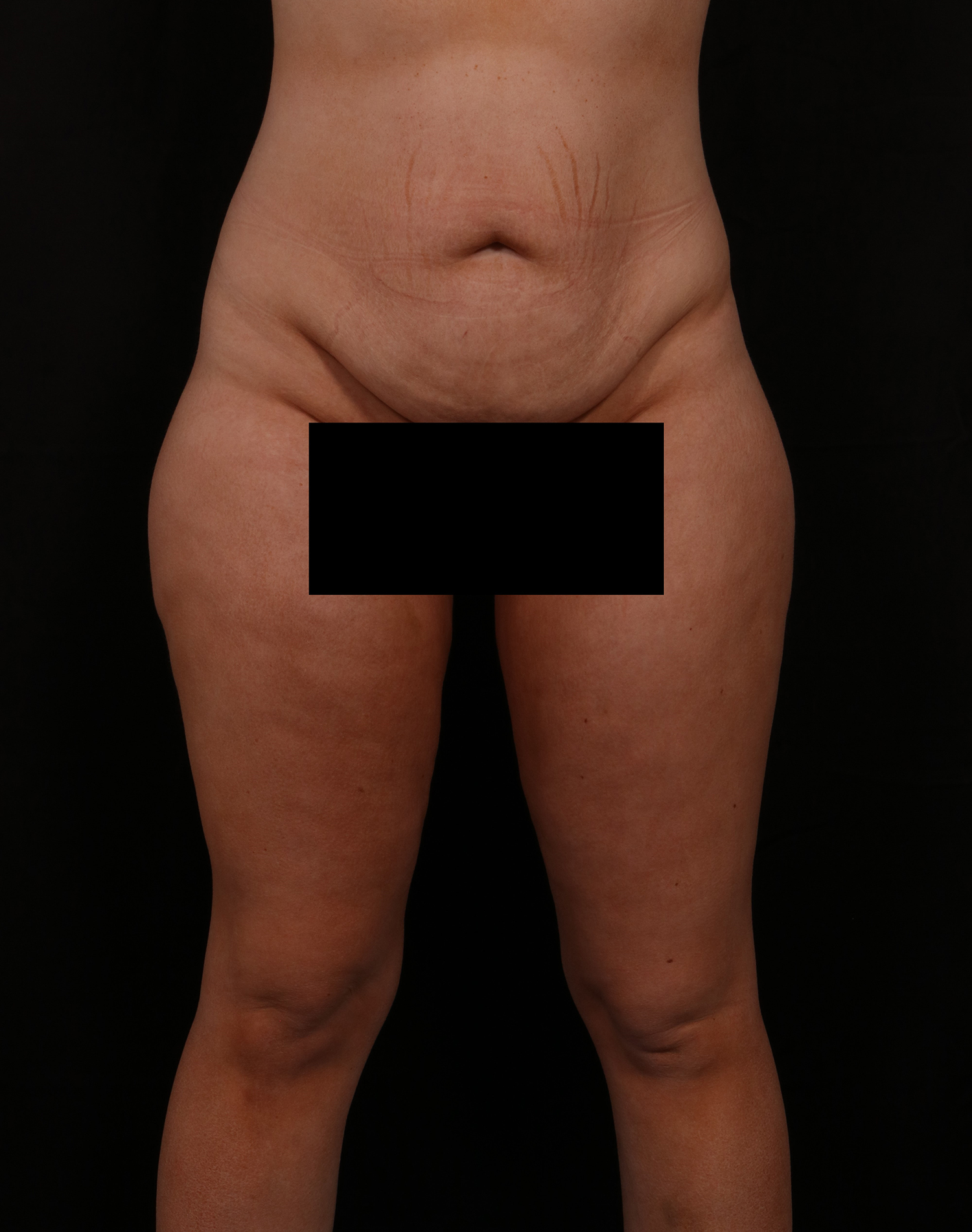 Before Image: Tummy Tuck - front