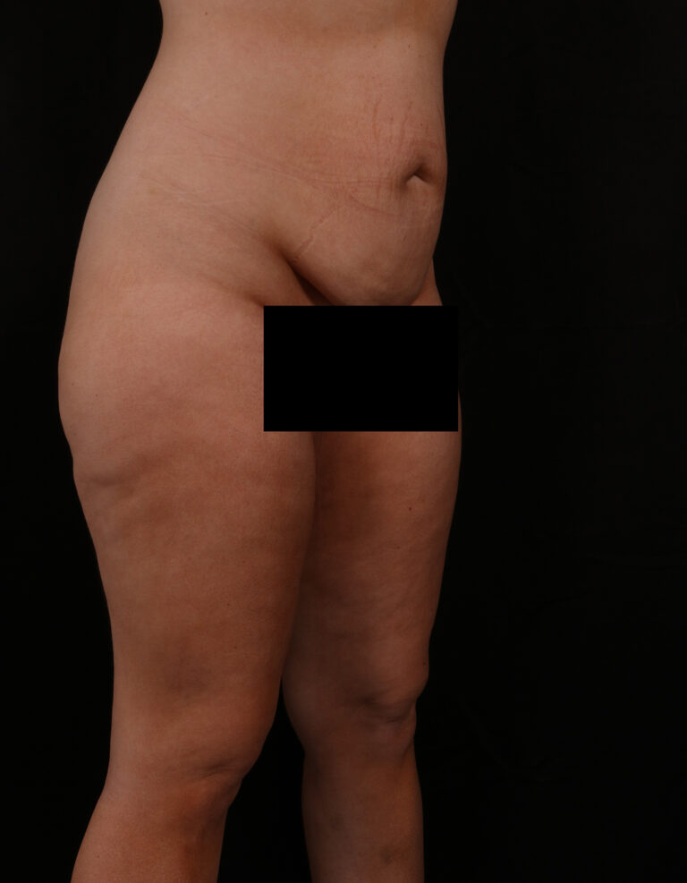 Before Image: Tummy Tuck - right-front-oblique