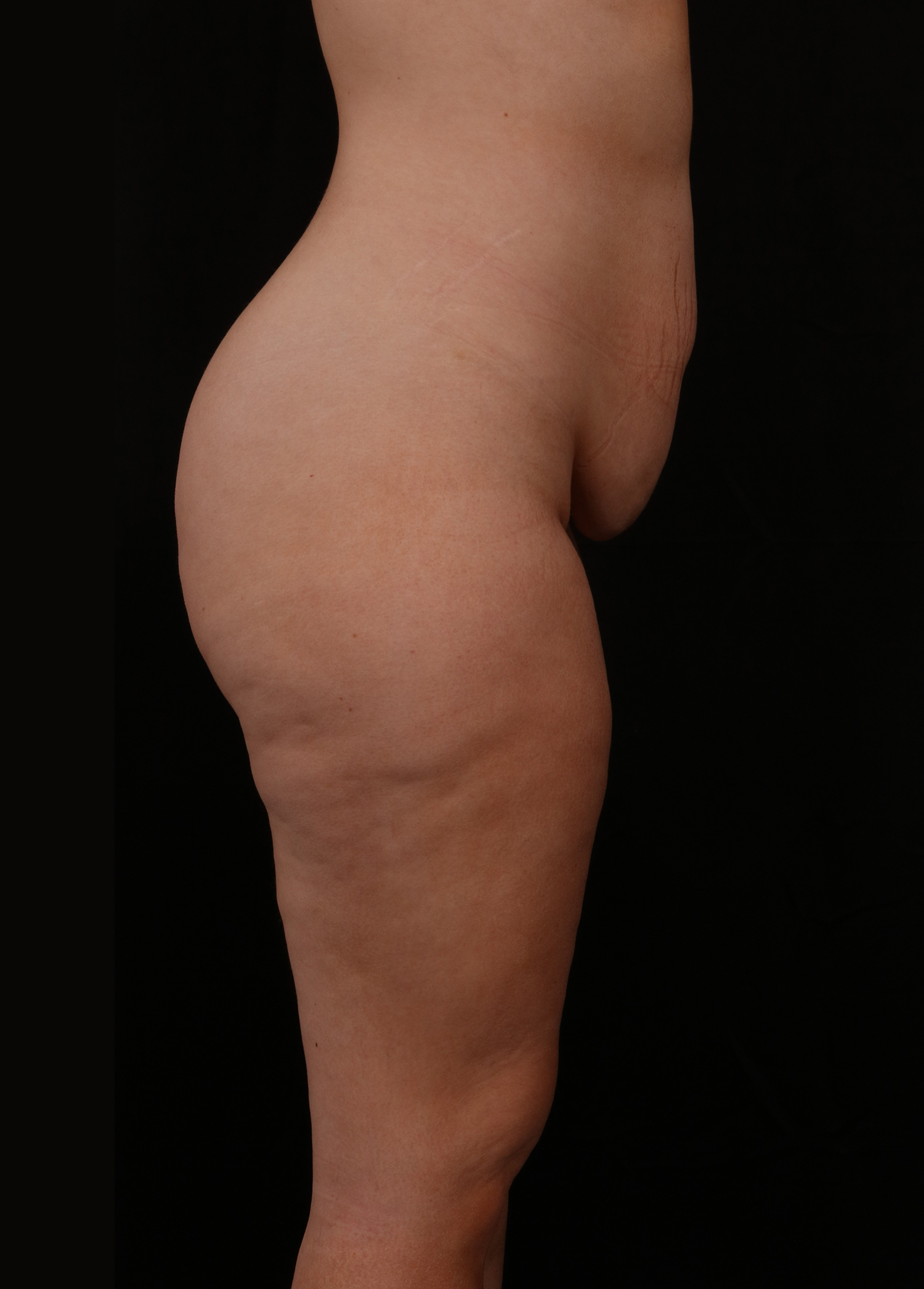Before Image: Tummy Tuck - right-side
