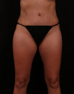 After Image: Tummy Tuck