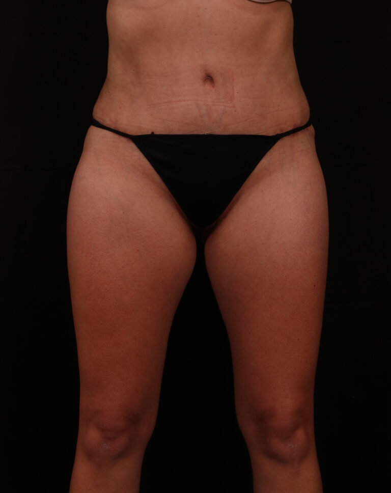 After Image: Tummy Tuck - front