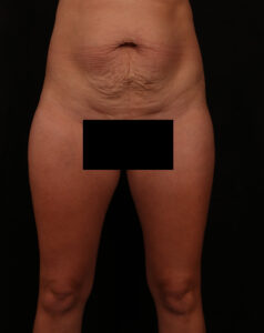 Before Image: Tummy Tuck