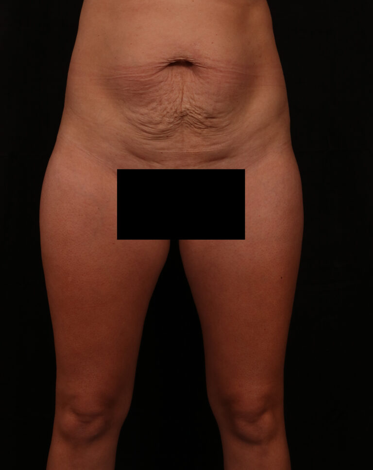 Before Image: Tummy Tuck - front