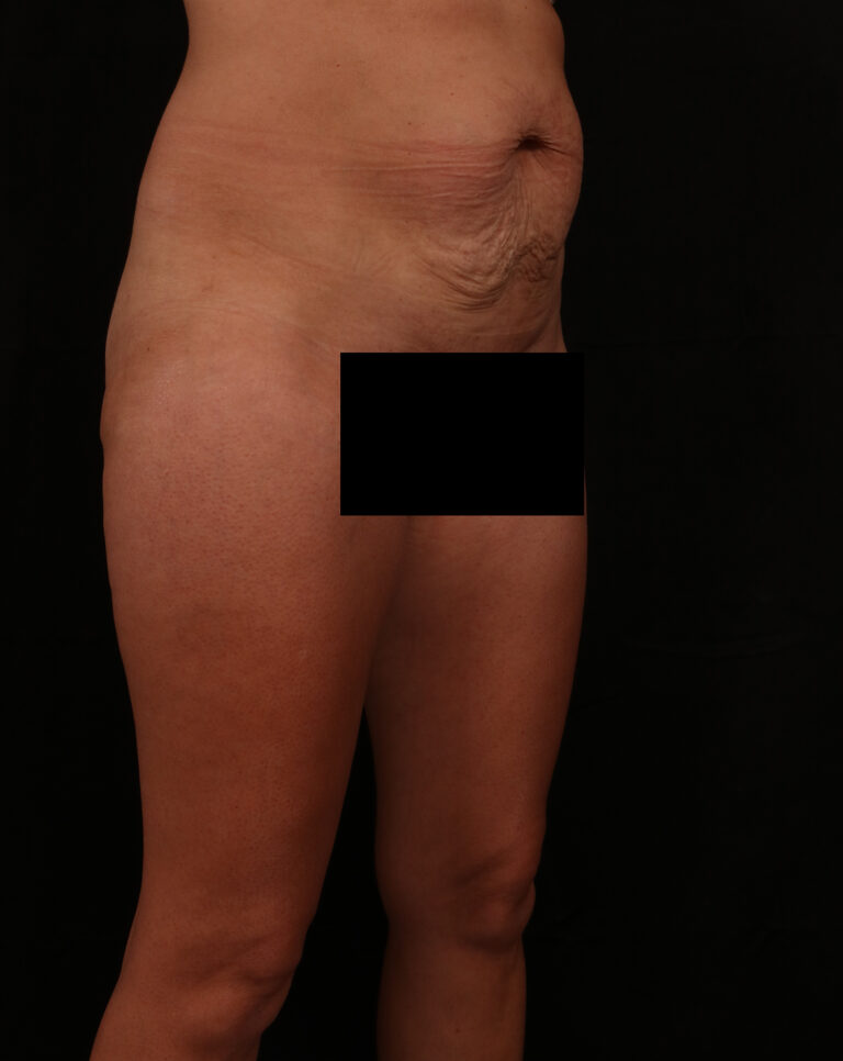 Before Image: Tummy Tuck - right-front-oblique
