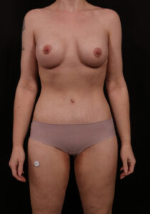 After Image: Mommy Makeover