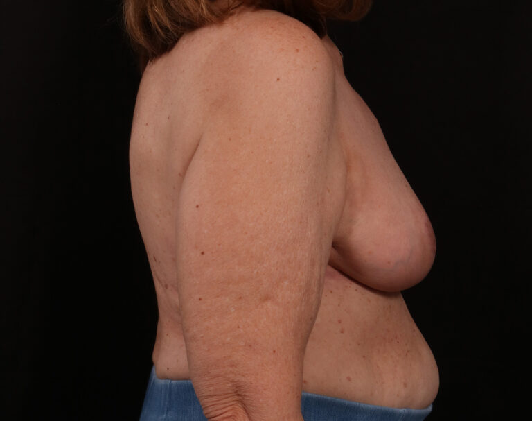 After Image: Breast Reduction - right-side