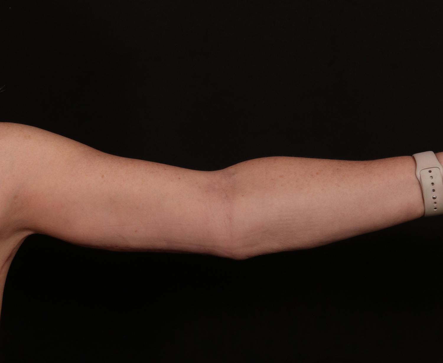 After Image: Brachioplasty - front