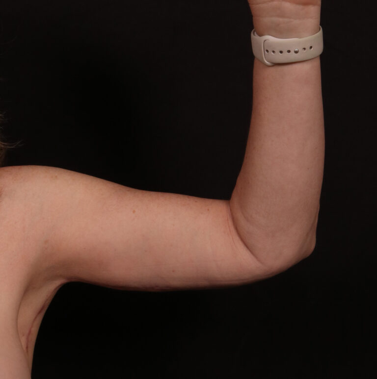 After Image: Brachioplasty - front