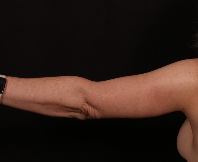 After Image: Brachioplasty - back