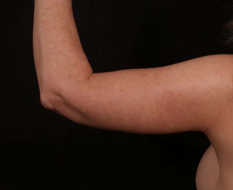 After Image: Brachioplasty - back
