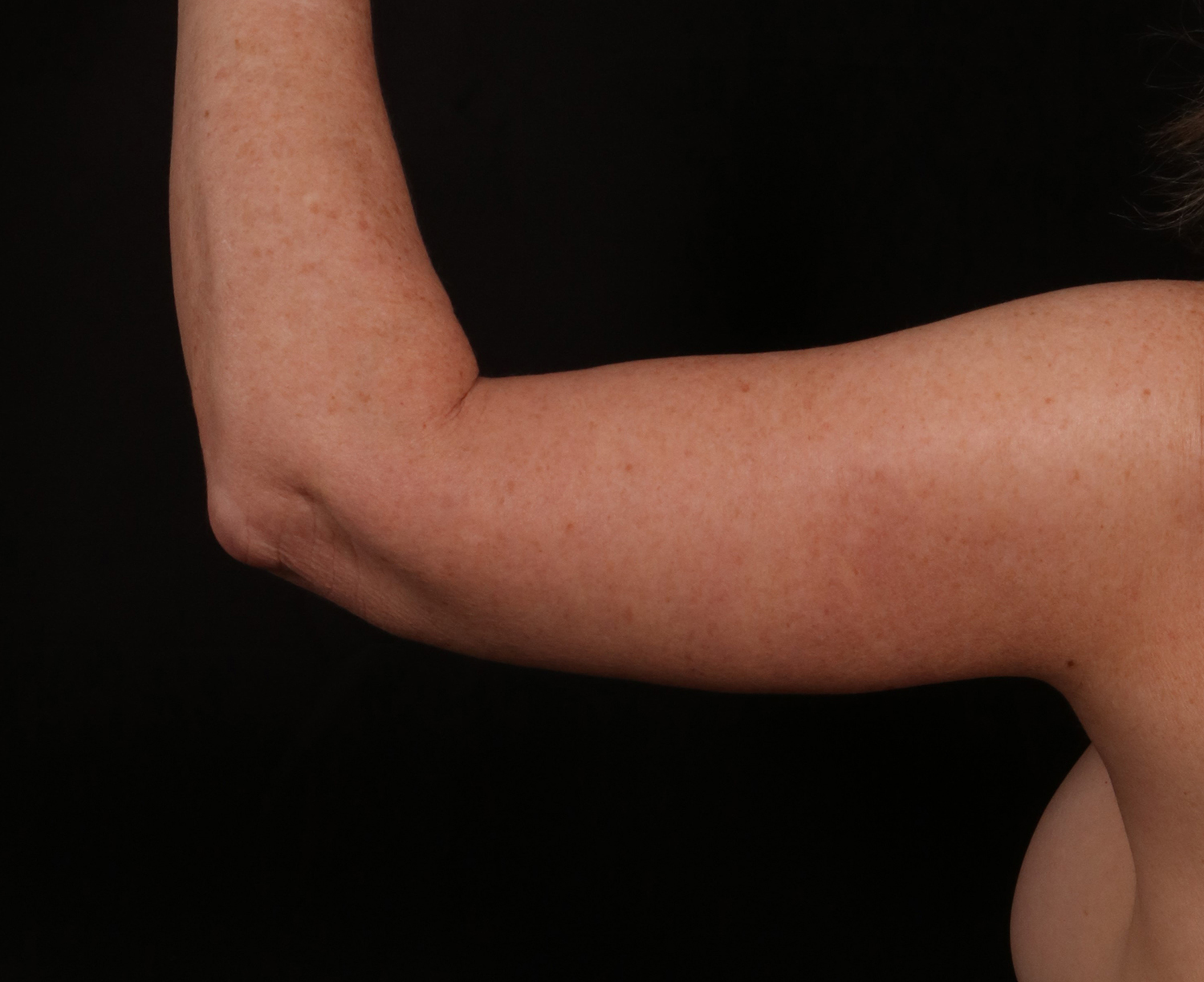 After Image: Brachioplasty - back