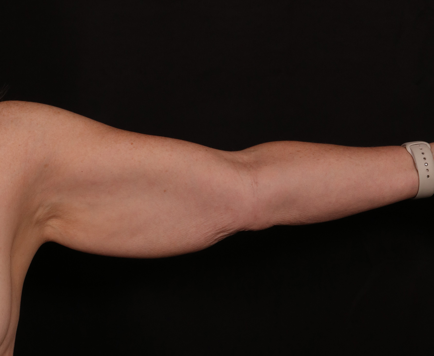 Before Image: Brachioplasty - front