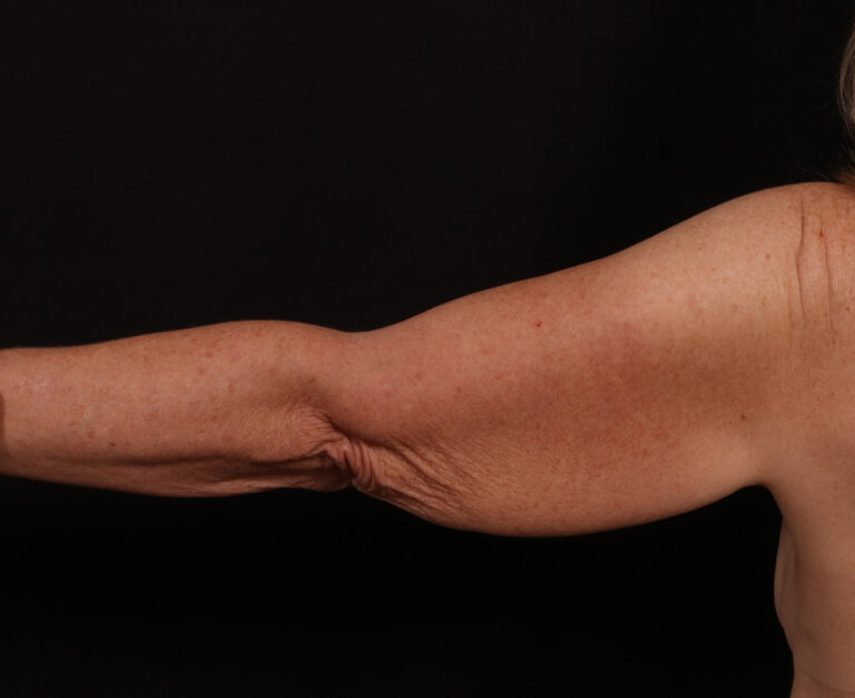 Before Image: Brachioplasty - back