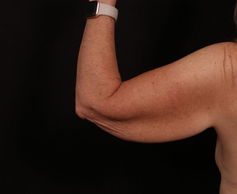 Before Image: Brachioplasty - back