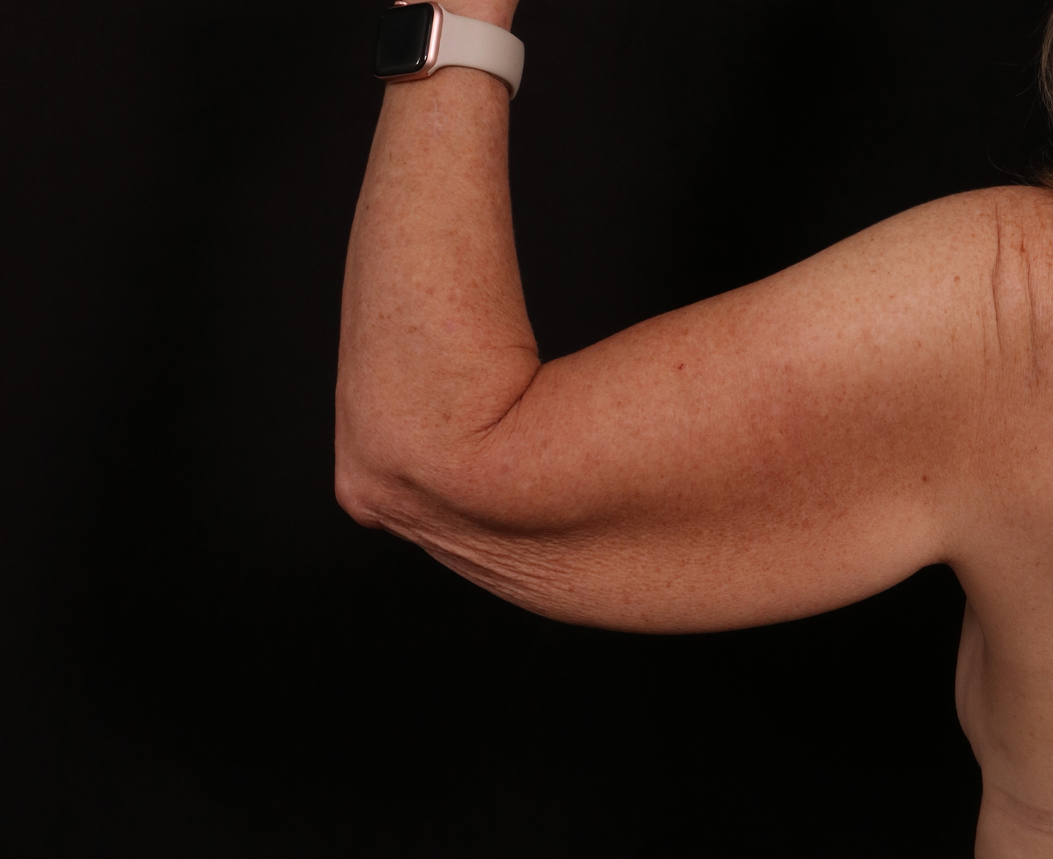 Before Image: Brachioplasty - back