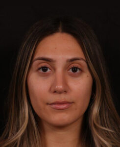 After Image: Rhinoplasty