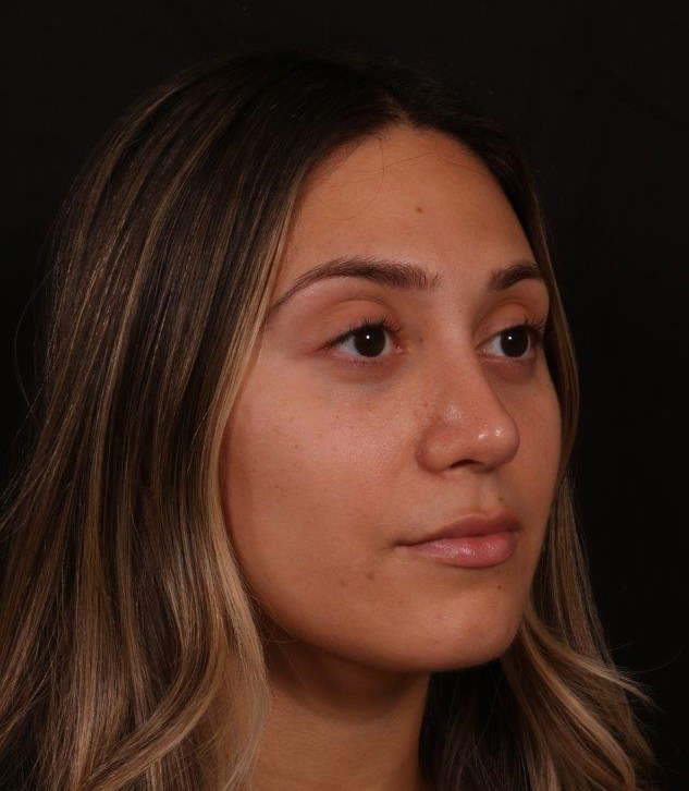 After Image: Rhinoplasty - right-front-oblique