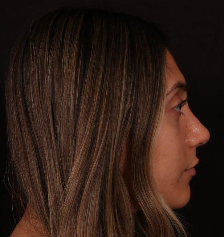 After Image: Rhinoplasty - right-side