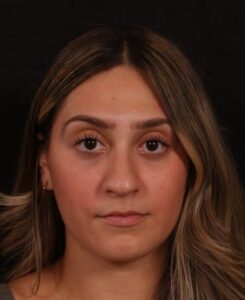 Before Image: Rhinoplasty