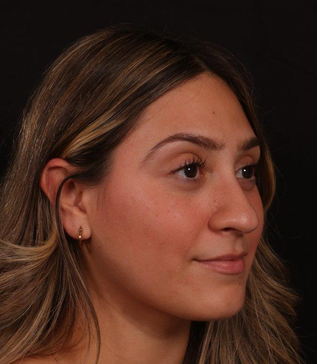 Before Image: Rhinoplasty - right-front-oblique