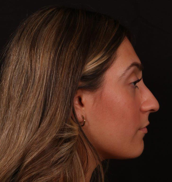 Before Image: Rhinoplasty - right-side