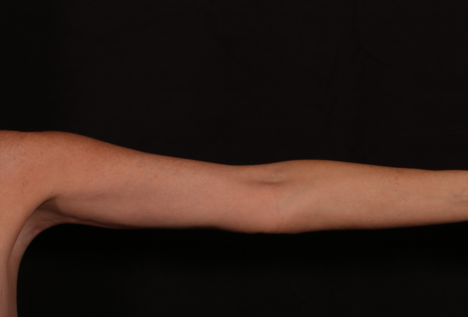 After Image: Brachioplasty - front