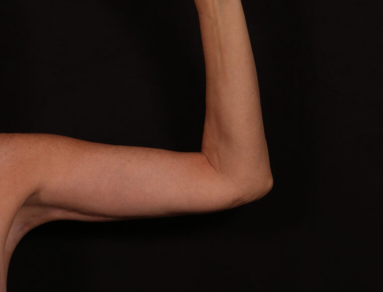 After Image: Brachioplasty - front
