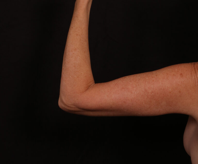 After Image: Brachioplasty - back