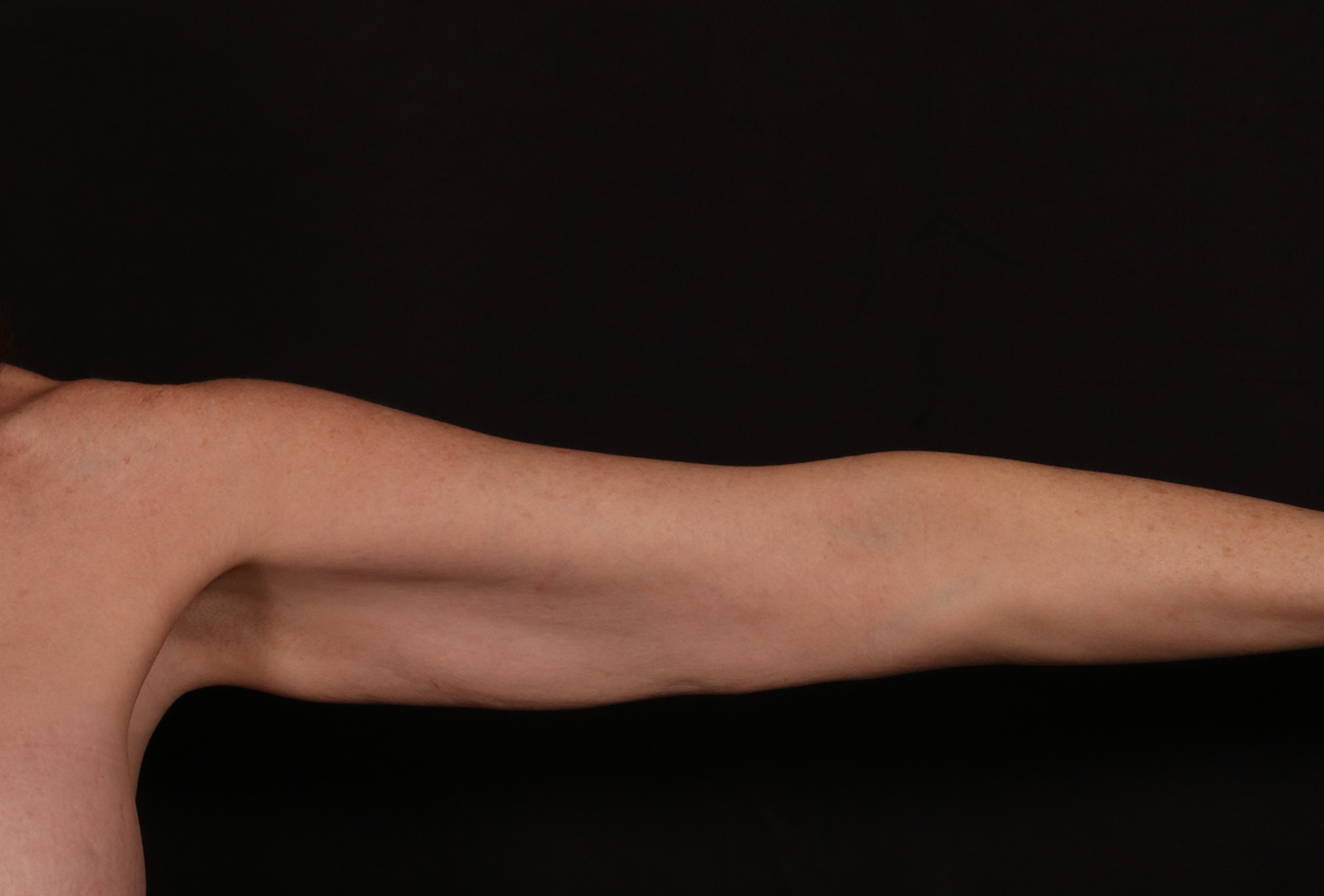 Before Image: Brachioplasty - front
