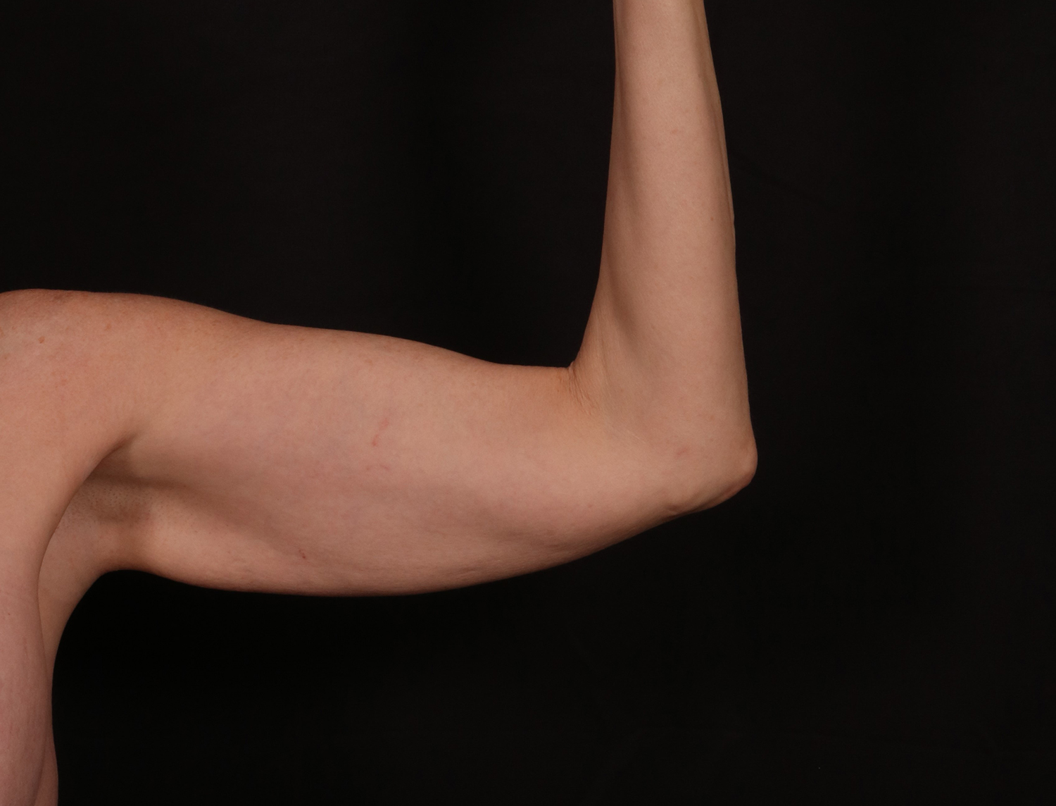 Before Image: Brachioplasty - front