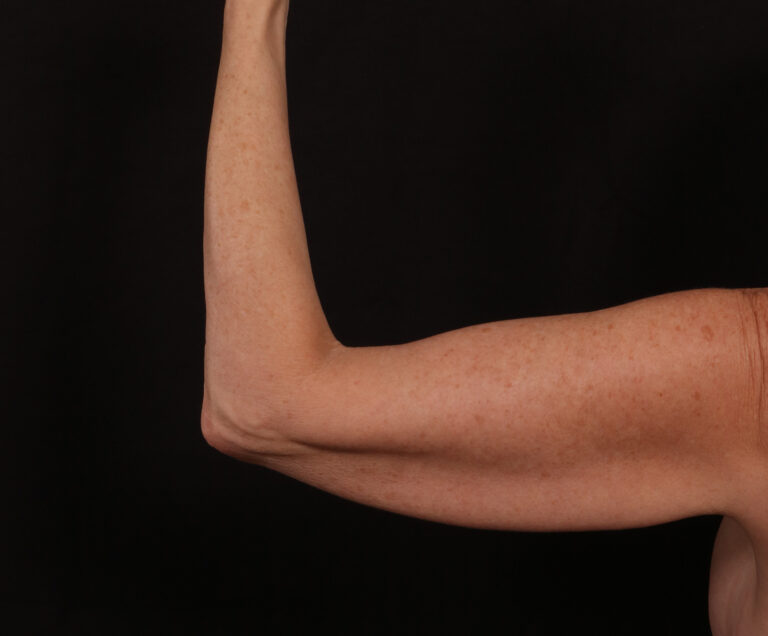 Before Image: Brachioplasty - back