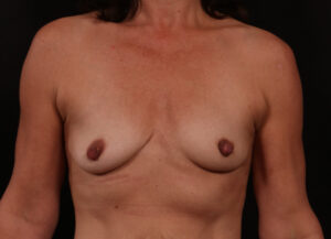 Before Image: Breast Augmentation with Peri Areolar Lift