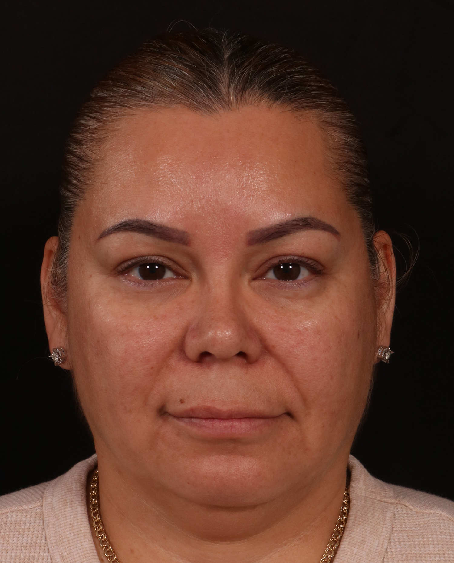 After Image: Rhinoplasty - front