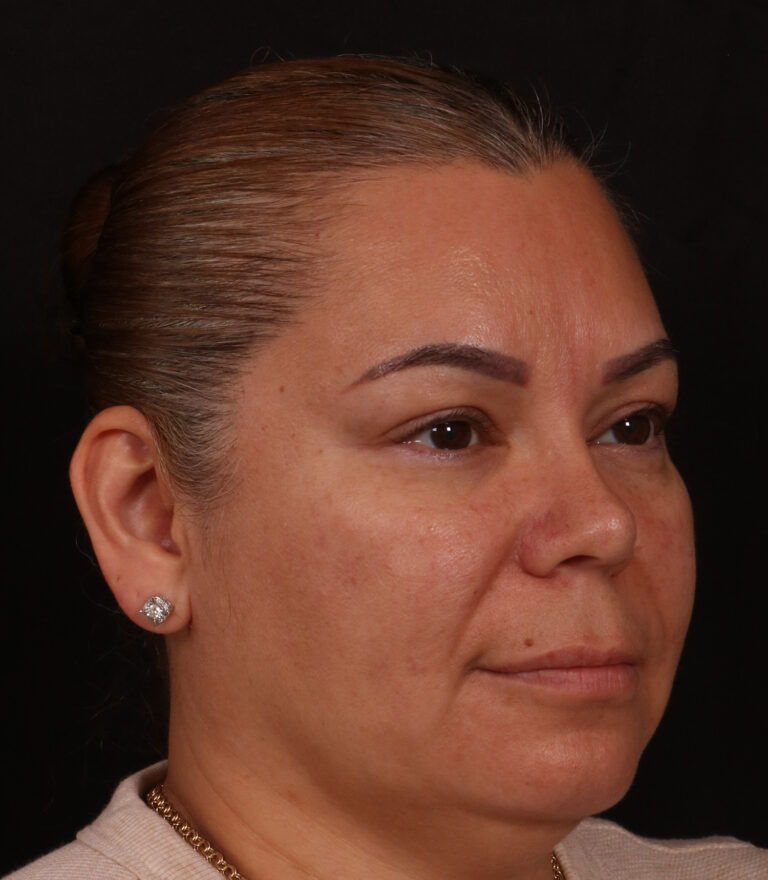 After Image: Rhinoplasty - right-front-oblique