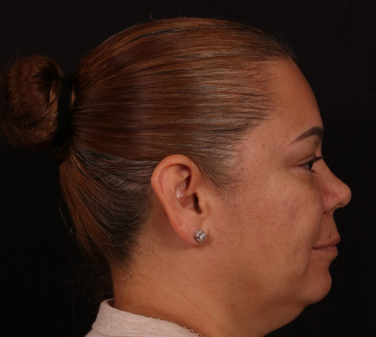After Image: Rhinoplasty - right-side