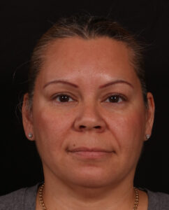 Before Image: Rhinoplasty