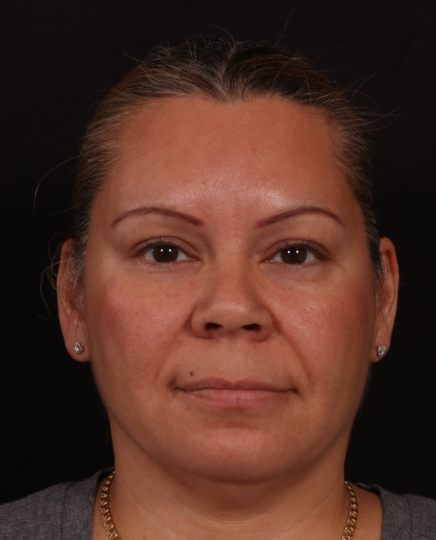 Before Image: Rhinoplasty - front