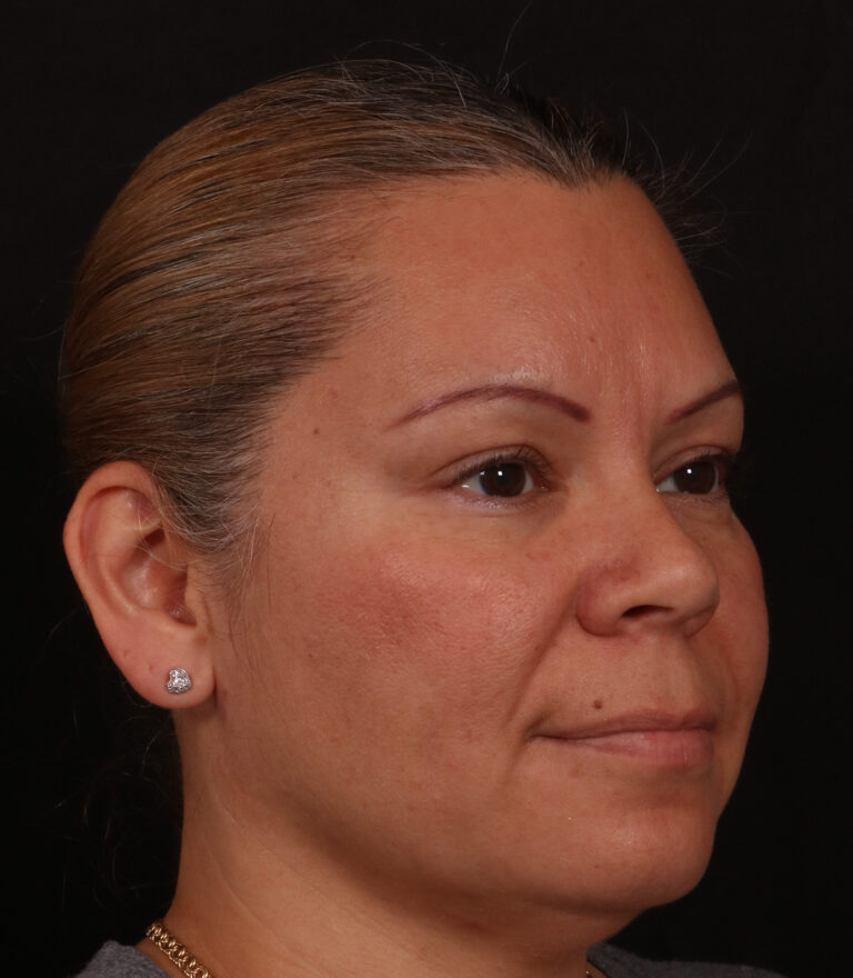 Before Image: Rhinoplasty - right-front-oblique