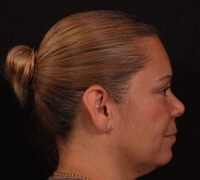 Before Image: Rhinoplasty - right-side