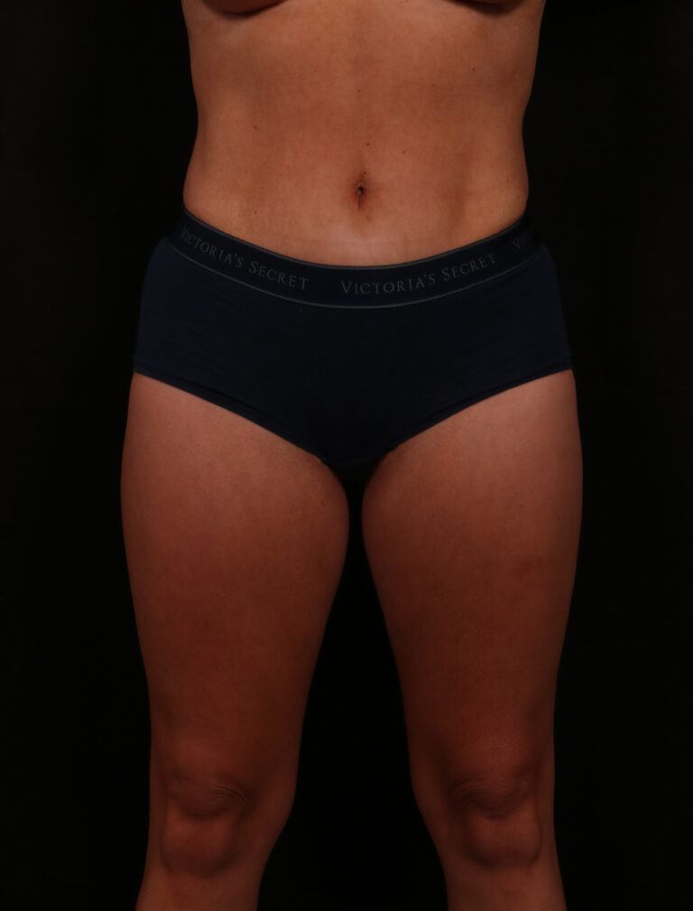 After Image: Liposuction - front