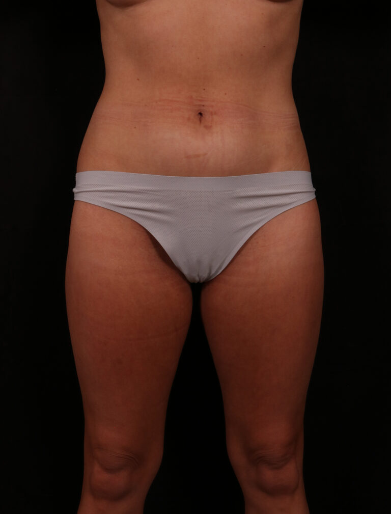 Before Image: Liposuction - front